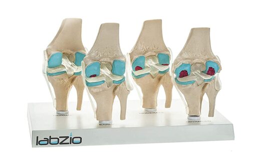 Model On Base 4 Stage Osteoarthritis Anatomical Knee Model with Detailed Study Guide 