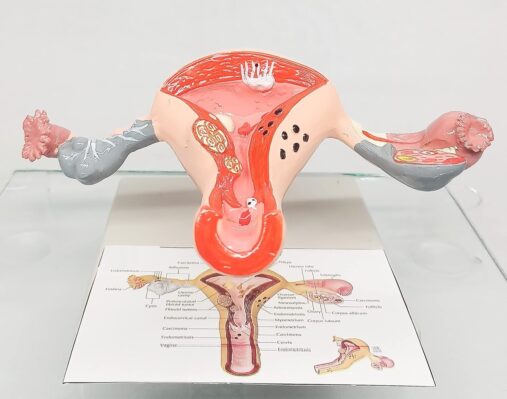 Uterus Ovary Model Body Anatomy Replica of Female Reproductive System Organ Anatomical Model with base showing the common Pathologies for Doctors Office Educational Tool