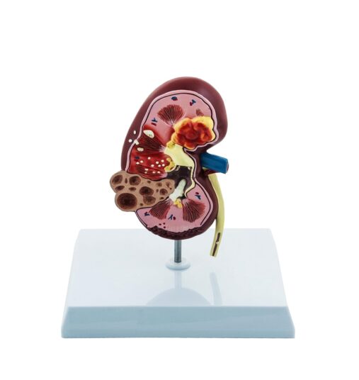 Deluxe Human Kidney Anatomical Model, Demonstrating Normal and Diseased Kidney with Pathologies, Medical Grade Anatomical Model