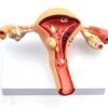 Uterus and Ovary Anatomy Model With Common Pathologies (Premium Quality)