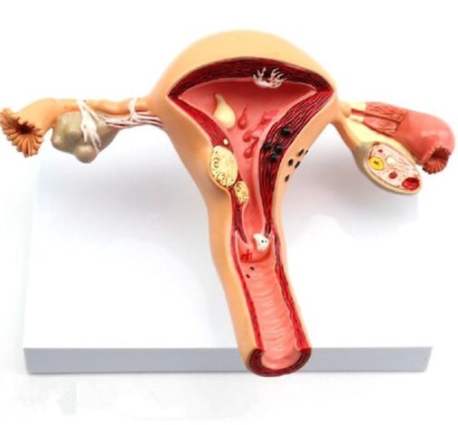 Uterus and Ovary Anatomy Model With Common Pathologies (Premium Quality)