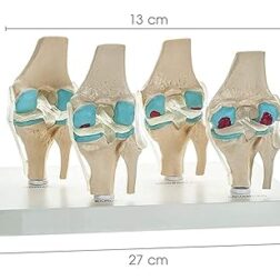 4 Stage Osteoarthritis Anatomical Knee Model, Model On Base, with Detailed Study