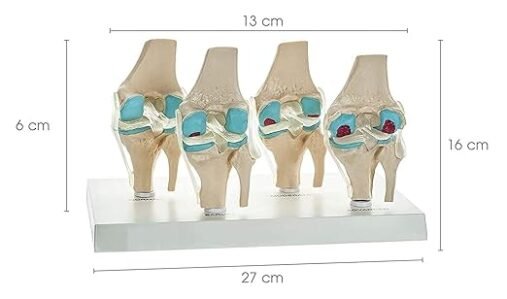 4-Stage Osteoarthritis Anatomical Knee Model on Base - Image 3