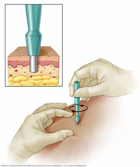 Disposable Biopsy Punch 3.0mm – Sterile Dermal Punch (Pack of 10) - Image 2