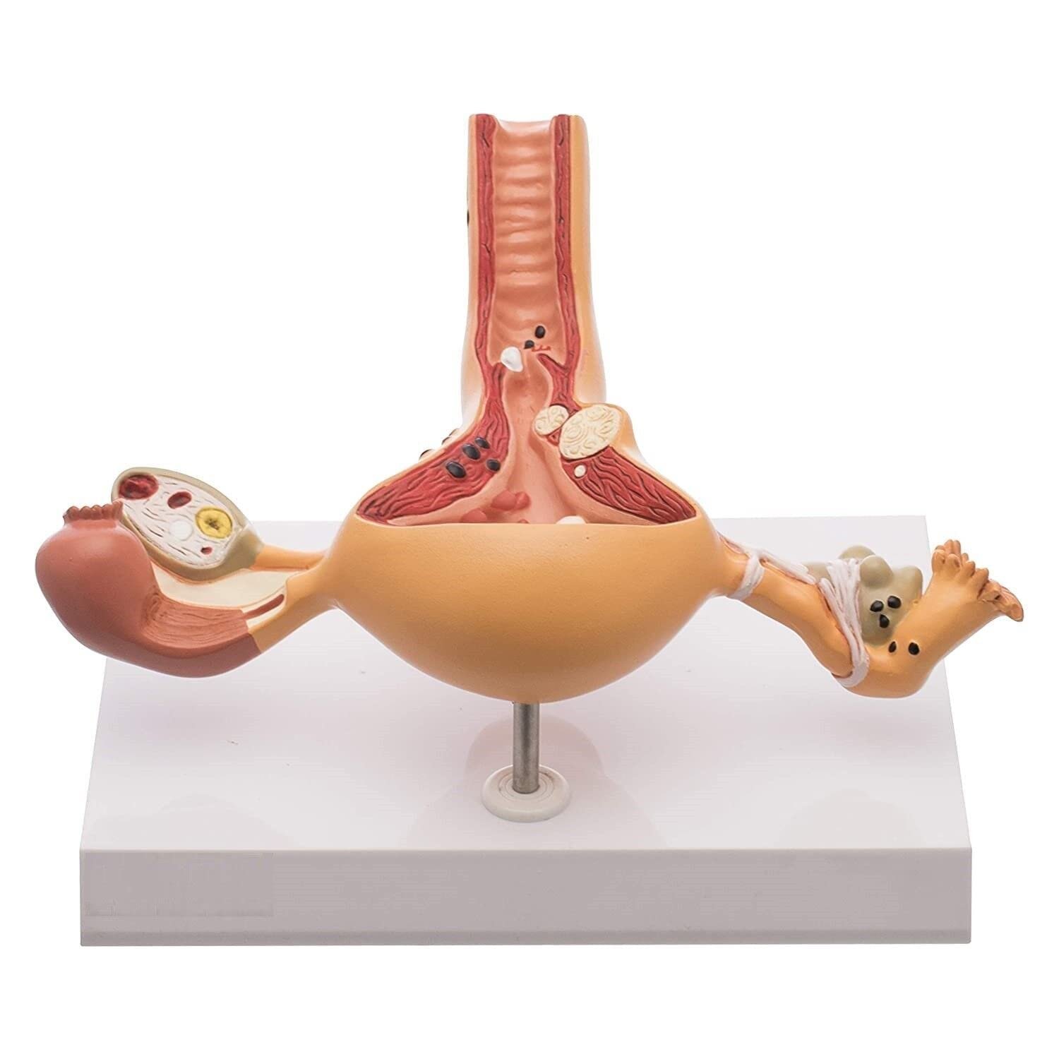 Ovary and Uterus Female Reproductive Organ Anatomical Model Common Abnormalities - Image 3