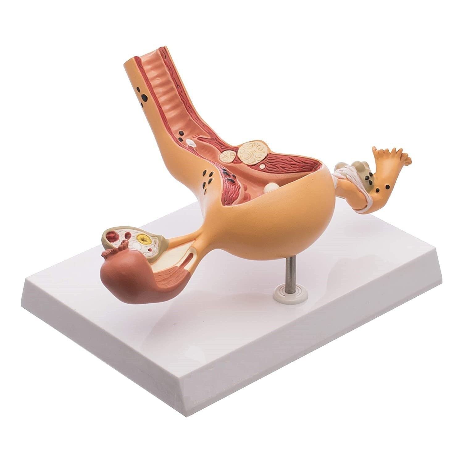 Ovary and Uterus Female Reproductive Organ Anatomical Model Common Abnormalities - Image 2