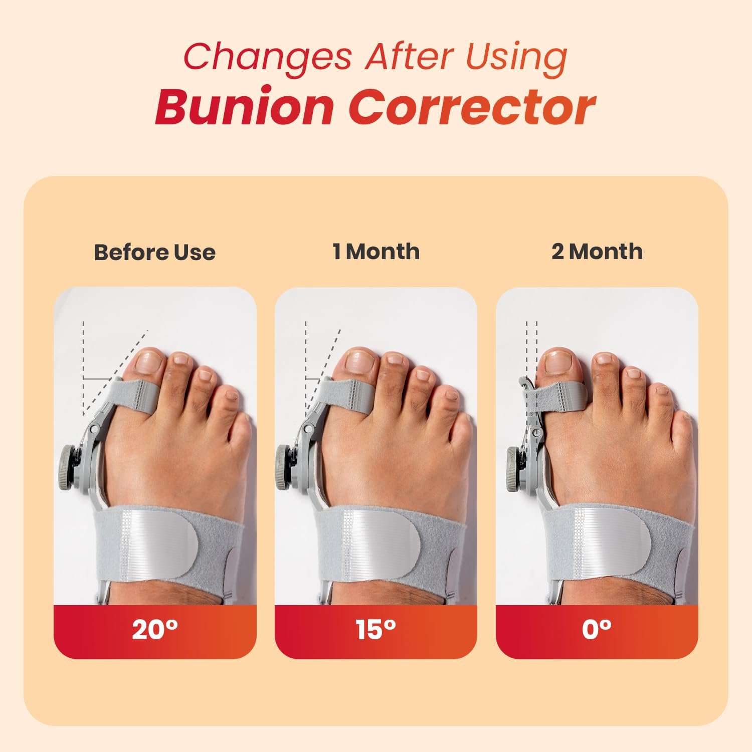 Bunion Corrector with Adjustable Splint & Rotating Knob - Image 7